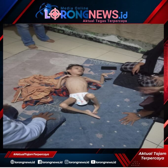 Miris…!!! Muhammad Rizki Firdaus (13) Alami Gizi Buruk, Penanganan Dugaan Stunting Disorot